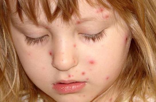 <p>Hastalığın getirdiği döküntüler ise, çocuklarda 1 veya 2 gün öncesinde bitkinlik ve karın ağrısı şikayetleriyle ortaya çıkar.</p>
