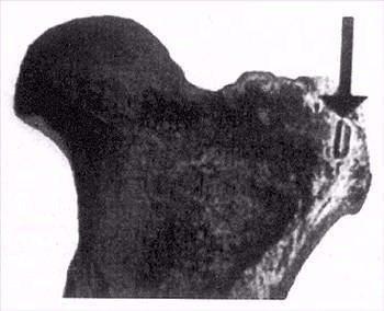<p>Tarih öncesi devirlerde yaşamış olan Toxodon 'nun bulunan bir kalça kemiği. (Arjantin). Resimde ok ile gösterilen şey ise bir ok veya mızrak ucudur. İnsanın yaşamadığını sandığımız devirde , biri onu avlamış anlaşılan.</p>