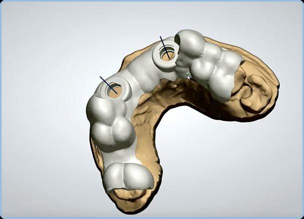 <p>Prof. Dr. Aysel Uğur da implantların biyolojik sistemle doğrudan temas halinde olan, ancak aynı zamanda sisteme yabancı materyaller olduğunu anlattı. Bu nedenle implantların doku ile uyumlu bir malzemeden yapılması ve bu malzemenin dokuya zarar vermemesi gerektiğinin altını çizen Uğur, “Daha da önemlisi kullanılacak bu materyallerin mekanik açıdan dayanıklı olması ve aşınmaması gerekir. Bu noktada, implantların yüzeyi önem taşır” dedi.</p>

<p> </p>
