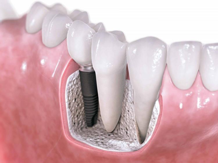 <p>İmplantlar, diş hekimlerince steril ortamlarda, küçük cerrahi bir işlemle çene kemiğine yerleştiriliyor. Bu işlem sonrasında yaklaşık olarak iki-üç ay içinde implant çene kemiğine tamamen tutunur.</p>

<p> </p>
