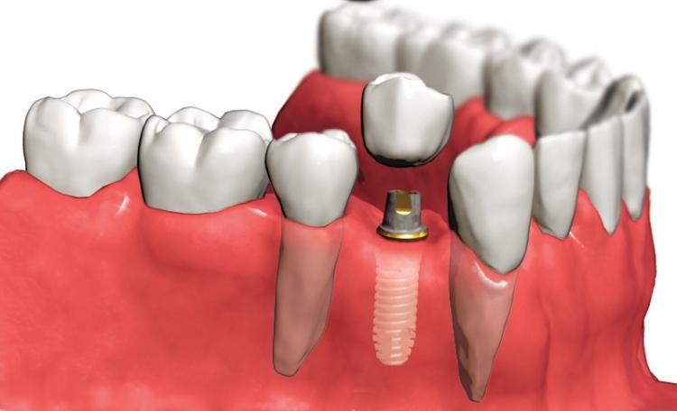 <p>Bu aşamalardan sonra gerçek bir diş kökünün yerini alan implant, üzerine konacak protezi taşıyacak duruma gelir.</p>

<p> </p>
