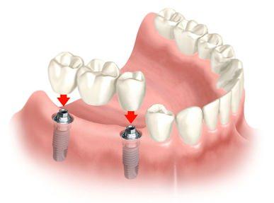 <p>İmplant uygulamasının yapılabilmesi için, öncelikle implantı destekleyecek kemik yapısının olması ve diş etlerinin sağlıklı olması gerekir.</p>

<p> </p>
