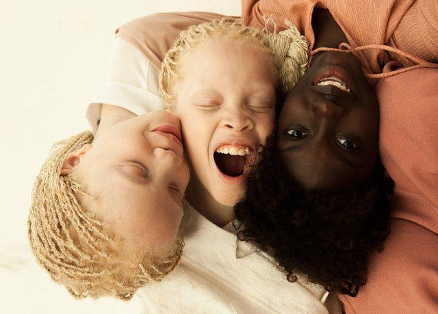 <p>İkizlerin 13 yaşındaki kardeşi <strong>Sheila</strong>'da albino hastalığı görülmemesine rağmen Terranova tarafından görüntülendi.</p>
