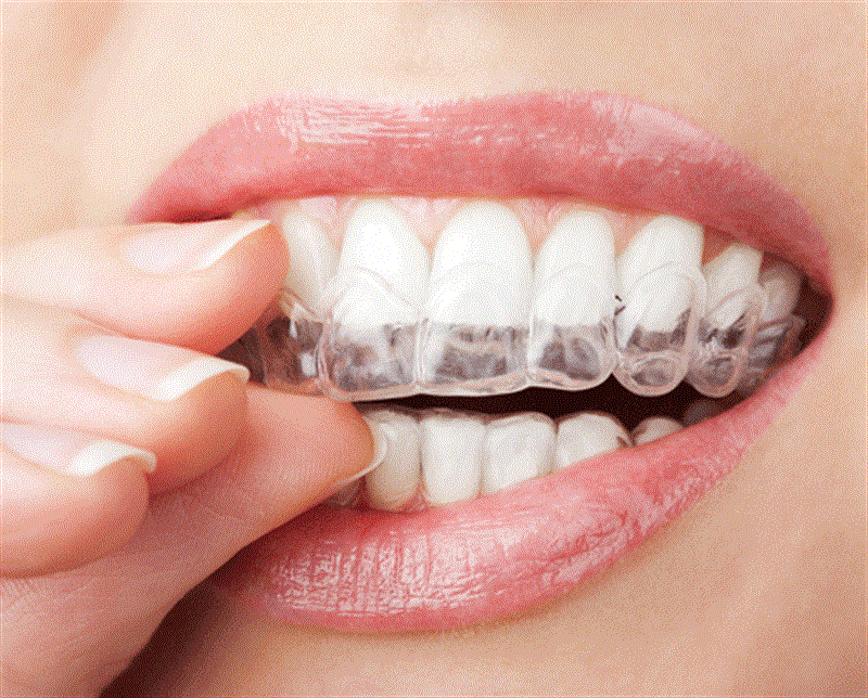 <p>Oysaki diş beyazlatma işlemi yapıldığında dişin mine ve dentin dokularına hiç dokunulmaz. Yalnızca dişin gözenekleri açılmış olur" dedi.</p>