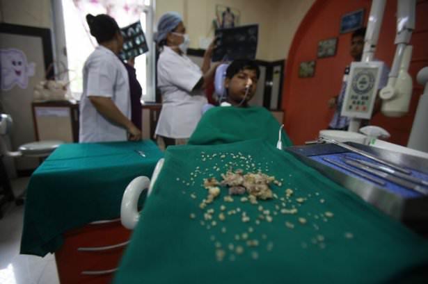<p>Hindistan'ın Mumbai kentinde 17 yaşındaki Ashique Gavai'nin çenesinden ameliyatla 232 diş çekildi. </p>
