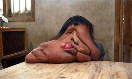 <p><strong>Neurofibromatosis</strong><br />
Neurofibromatosis (NF) kemikleri, yumuşak dokuyu, deriyi ve sinir sistemini etkileyen genetik bir hastalıktır.</p>