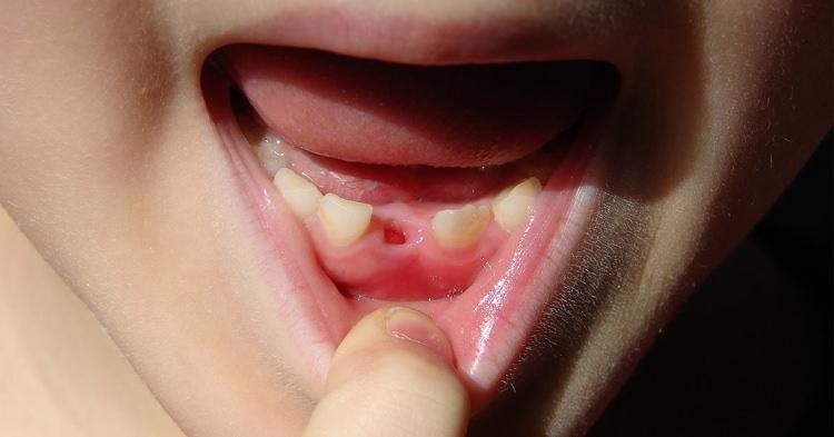 <p><strong>Doktorların görüşü, ilk dişlerin atılmaması yönünde.</strong></p>
