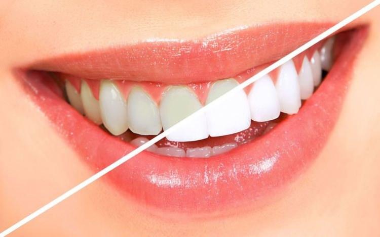 <p>Dr. Recep Eşkar, piyasada satılan diş beyazlatıcı ürünlerin ya da ev ortamında kullanılan beyazlatıcı jellerin birçok olumsuzluğu beraberinde getirdiğini belirterek, diş beyazlatma işleminin mutlaka hekim kontrolünde yapılması gerektiğini vurguladı.</p>
