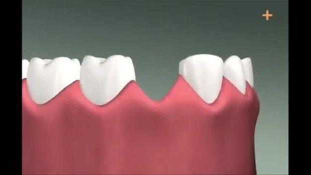 <p>Diş implantı nasıl yapıldığını gösteren görüntüler büyük ilgi görüyor.</p>

<p> </p>
