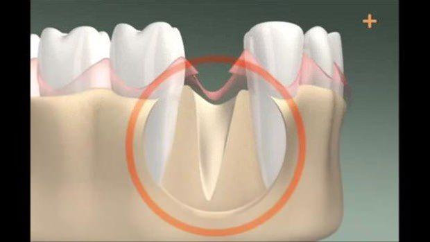 <p>İşte diş implantının yapılışı!</p>
