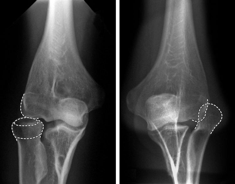 <p><strong>OSTEOGENEZİS İMPERFEKTA: </strong><br />
<br />
Halk arasında 'cam kemik' olarak bilinen hastalıkta; kemiğin temel maddesini oluşturan bağ dokusunda kalıtsal bir bozukluğa bağlı olarak ortaya çıkıyor. </p>