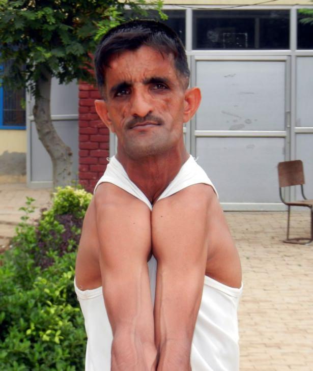 <p>Hindistan'da yaşayan bu adam omuzlarını tıpkı bir lastik gibi kullanabiliyor. Görenlerin dönüp dönüp tekrar baktığı Rammehar Punia'nın gerçek görüntüsünü anlamak neredeyse imkansız.</p>

<p> </p>
