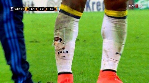 Fenerbahçeli yıldızın bacağı bu hale geldi!