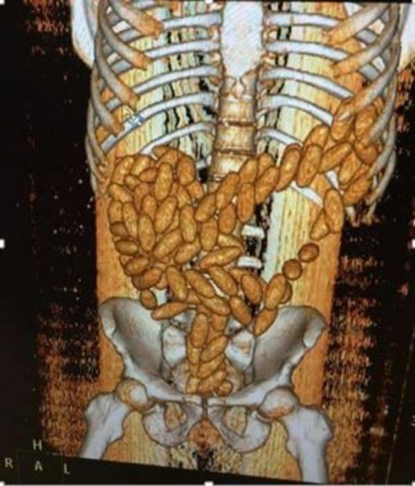 <p>M.M'nin midesindeki kapsüller doğal yollarla çıkarıldı. Ele geçirilen 111 kapsülde 480 gram esrar olduğu belirlendi.</p>
