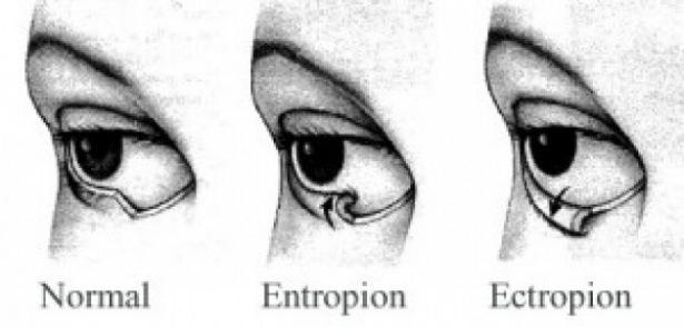 <p>Blefarospazm tanısında hastanın geçmiş şikâyetlerinin ve yüzünün değerlendirilmesinin <br />
önemli olduğunu vurgulayan uzmanlar “Maalesef hastalığı gösteren özel bir <br />
görüntüleme yöntemi ya da kan testi henüz mevcut değil. Bu nedenle teşhis <br />
için doğru ve emin adımlarla ilerlenmesi gerekiyor” diyor.</p>
