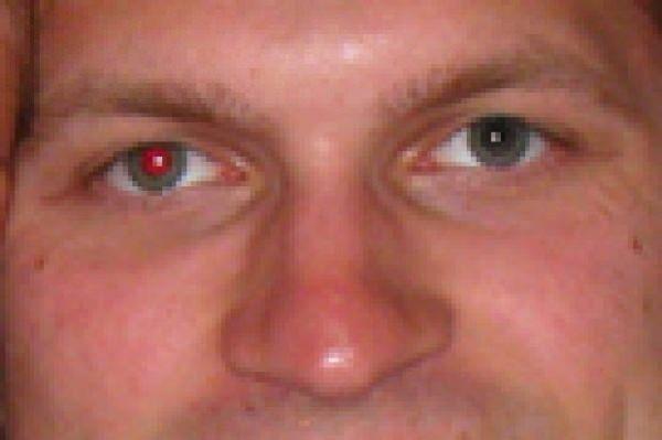 <p>Eğer bir fotoğrafınızda sadece bir gözünüz kırmızı çıktıysa, bu retinoblastom (bir çeşit göz kanseri) belirtisi olabilir.</p>