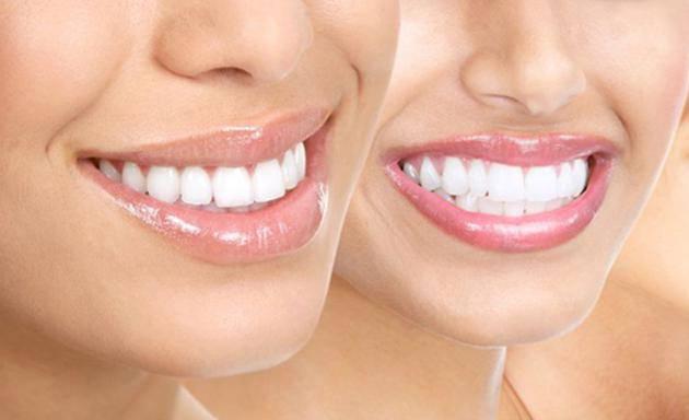 <p>Klinik ortamda diş beyazlatma işlemi yaptıran herkes işlemin sıklığını merak eder. Uzmanlar, sürekli diş beyazlatma işleminin dişler için mine ve doku kaybı yaratacağı gibi, </p>
