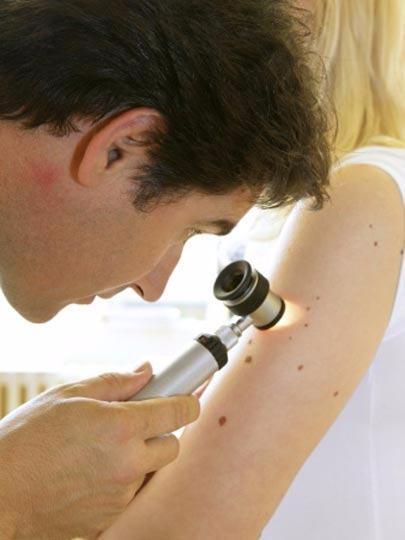 <p>"British Journal of Dermatology" dergisinde yayımlanan çalışma, vücudunda 100'den fazla ben olan kişilerin...</p>
