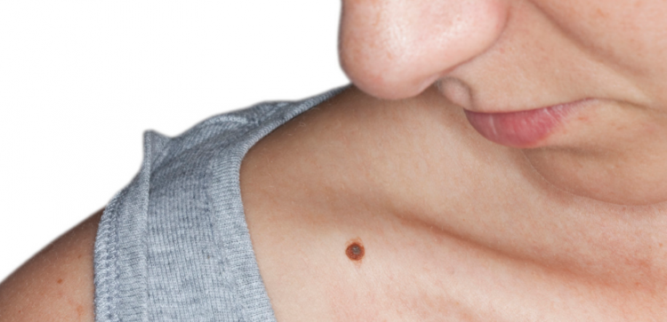 <p>Buna göre sağ kolunda 7'den fazla ben olanların cilt kansere yakalanma riski, bütün vücudunda 50'den fazla ben olanlardan dokuz kat fazla.</p>
