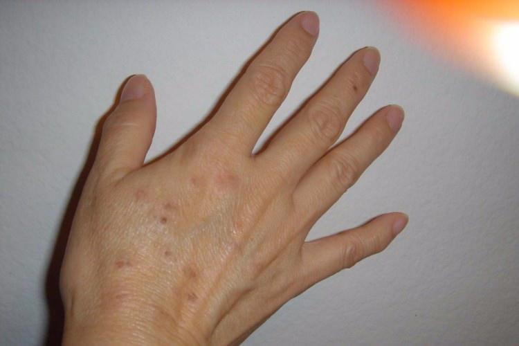 <p>Sağ kolunda 11'den fazla ben olanlarda ise cilt kanseri görülme olasılığı, vücudunda toplam 100 ben olanlardan daha yüksek.</p>