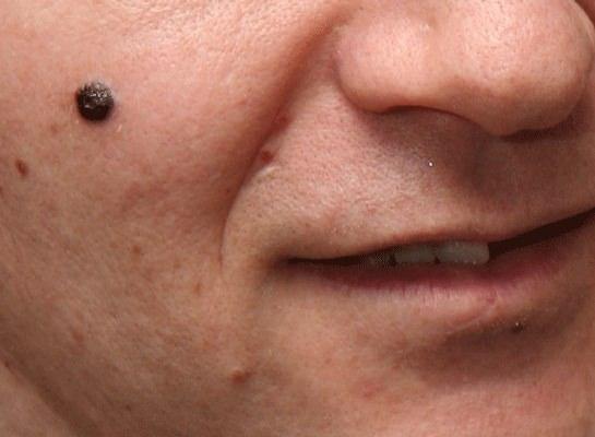 <p>Bilgiler, cilt kanserinin bir türü olan melanom teşhisi konulan 400 erkek ve kadından elde edilen veriyle karşılaştırıldı.</p>