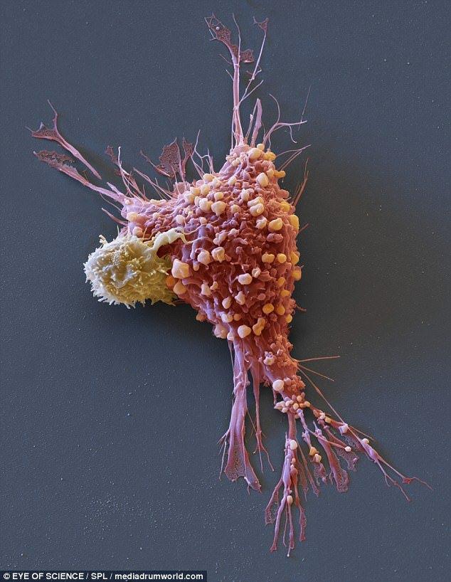<p>Bu renkli tarama, sarı CAR-T hücrelerinin saldırısına uğramış bir göğüs kanseri hücresinin canlı pembe görüntüsünü gösterir. 2014'teki kadın kanserlerinin yüzde 31'i bu şekilde.</p>
<p> </p>