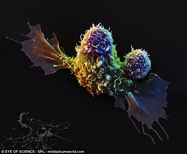 <p>Bu SEM, CAR- T hücrelerinin (mor) saldırısına uğramış bir ependimoma (sarı ve yeşil) olarak görülür. Bu tür tümörler, beyin ve merkez omurilik kanal boşluklarını kaplayan hücrelerden ortaya çıkar.</p>
<p> </p>