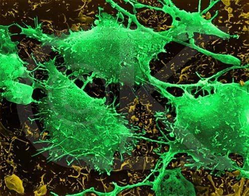 <p>Taranan elektron mikroskopu (Scanning Electron Micrograph SEM) ile alınan renkli resimler, Kimerik Antijen Reseptörü (CAR) tarafından saldırıya uğramış kanser hücrelerinin şok edici canlı renklerini gösteriyor. </p>

<p> </p>
