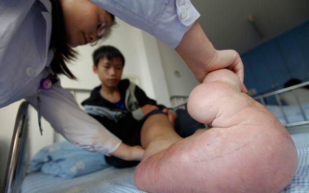 Zyao Mangum adındaki &ccedil;ocukta, konjenital n&ouml;rofibromatozis adı verilen bir bozukluk teşhisi konuldu.