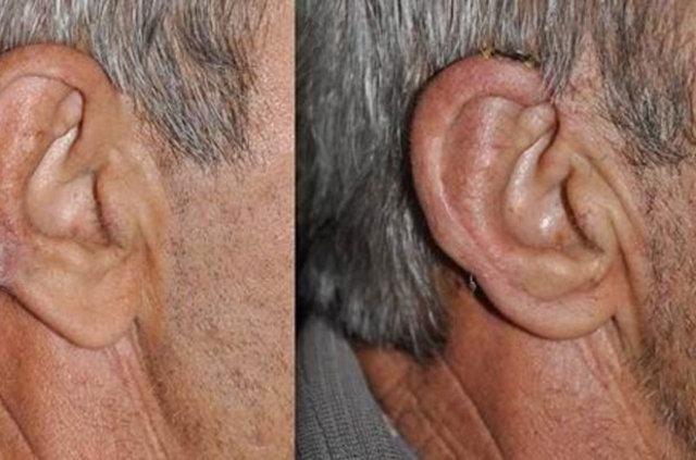 <p>Daha önce felç geçiren 241 kişinin bir araya geldiği çalışmada, insanların dörtte üçünün kulak memesinde kırışıklık tespit edildi.</p>