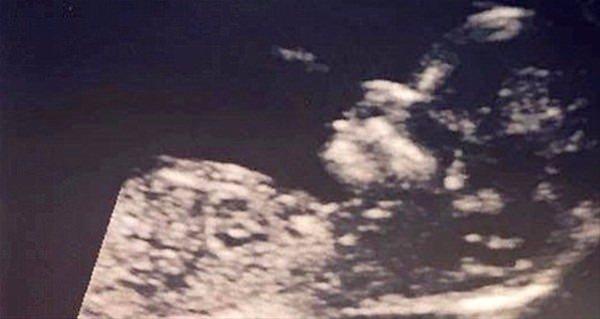 <p>Bebeğin sa&ccedil;lı olarak doğacağı ultrason g&ouml;r&uuml;nt&uuml;leriyle belli oldu.</p>

<p>&nbsp;</p>
