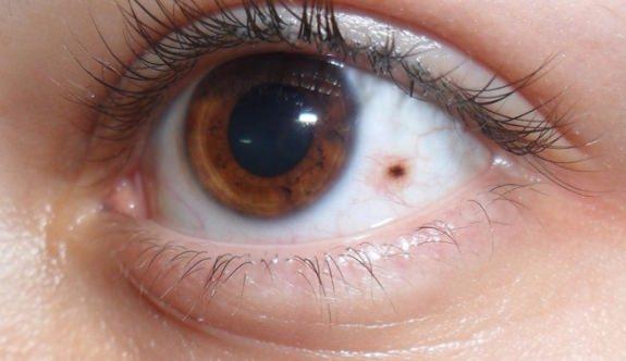 <p>Gözün çevresinde bazı nedenlerden dolayı lezyonlar görülebilir. Bu lezyonlar kötü huylu tümörlerin habercisi olabilir.</p>
