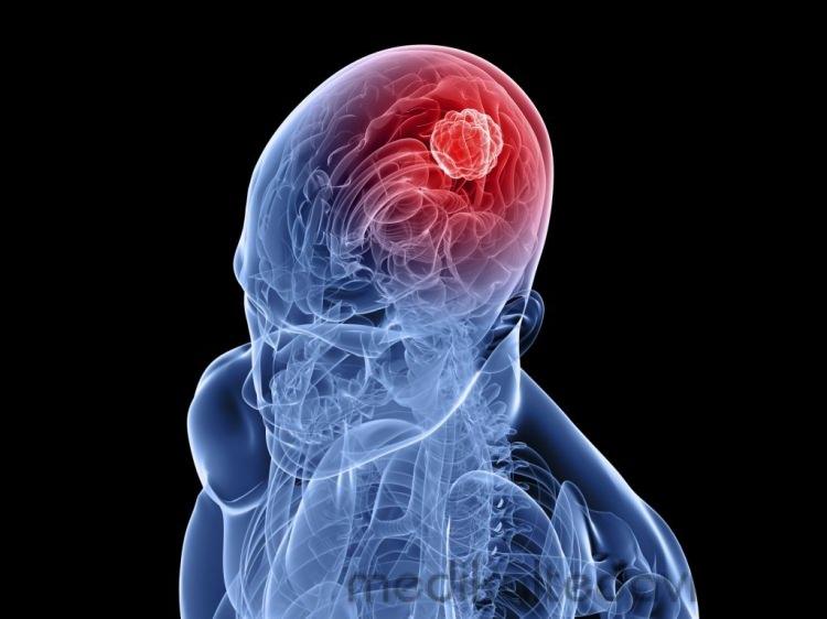 <p>Beyni besleyen damarların birinde ya da birkaçından kanın dışarı sızması nedeniyle beslenen bölgenin işlevini yitirmesi ve çalışamaz duruma gelmesine beyin kanaması denir.</p>
