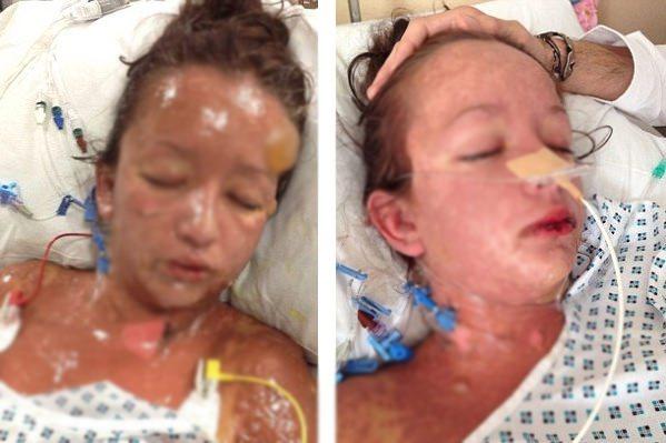 <p>Aldığı mide ilacı gen&ccedil; kızın cildinde &ouml;yle bir alerjik reaksiyona neden oldu ki, kızın b&uuml;t&uuml;n hayatı karardı. T&uuml;m cildinde korkun&ccedil; yaralar &ccedil;ıkan gen&ccedil; kızın kaş kirpik, sa&ccedil; ve hatta tırnakları bile d&ouml;k&uuml;ld&uuml;.</p>