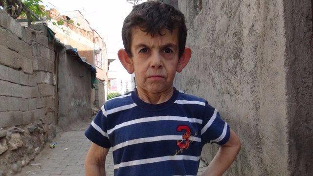<p>Suriyeli Muhammed Adem henüz sekiz yaşında. Dünyada 2 milyon bebekte bir görülen rahatsızlığının adı ‘cutis laxa’. Muhammed’in görünümü 60-70 yaşlarında birini andırıyor.</p>

<p> </p>

<p><strong>KAYNAK: HÜRRİYET </strong></p>
