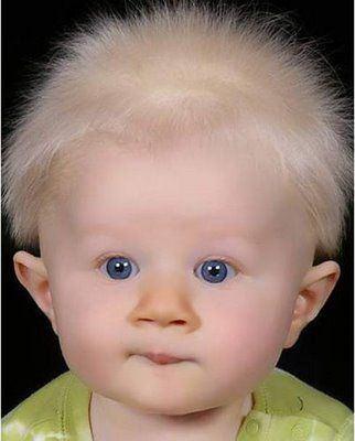 <p>87- ADEM</p>
