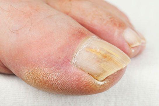 <p>Ayak mantarı, mantar mikrobunun uzun süre kapalı kalan ayakların, nemli ve sıcak olmasından dolayı, deri üzerinde büyümesiyle oluşur. </p>
