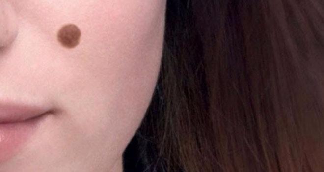 <p>Ancak vücudunuzdaki benleriniz büyüyor, kaşınıyor veya kanıyorsa vakit kaybetmeden dermatologunuza başvurmalısınız. </p>
