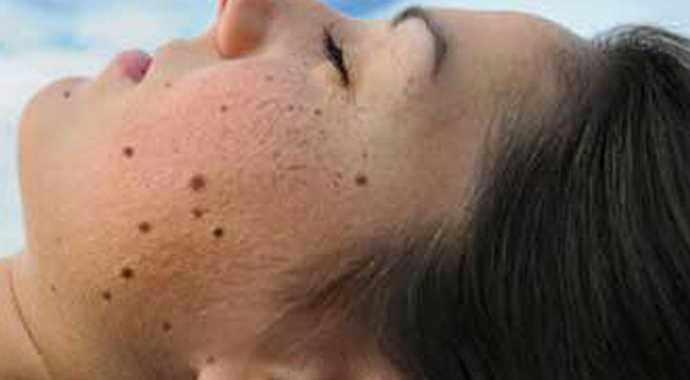 <p>Ayrıca eskiden beri varolan bir ben zamanla boyut, renk ve şekil değiştirdiyse mutlaka bir dermatologa başvurulmalıdır. </p>