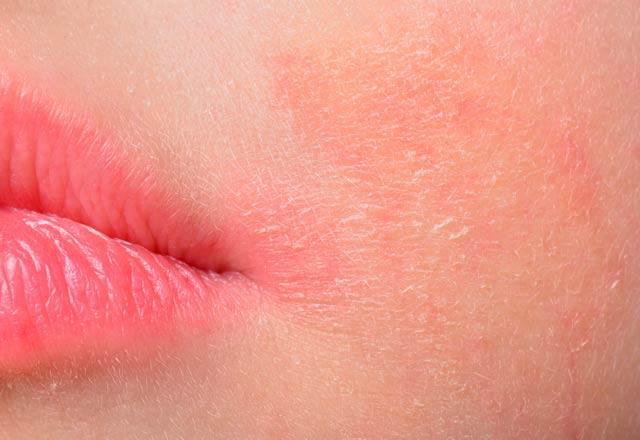 <p>Karpuz, kavun ve domates gibi meyveleri yedikten sonra, dudaklarında kenarında oluşan kızarıklık ve kaşıntı alerjinin belirtileridir.</p>
