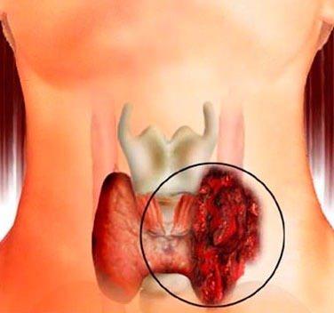 <p>"Tiroit hormonunun normal değerlerden daha az salgılanmasına hipotiroid denir.</p>
