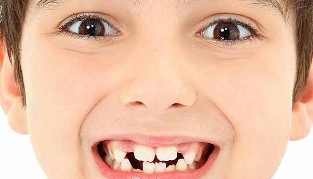 <p>Diş aralarında boşluk olan çocukların konuşmakta güçlük çektiklerine değinen Yrd. Doç. Dr. Sanaz Sadry, </p>
