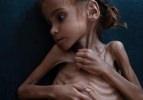 Yemen'deki savaşın kurbanları: Masum &ccedil;ocuklar!