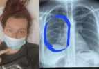 Elektronik sigara içen kadının ciğerleri patladı! Sakın ağzınızı bile sürmeyin
