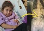 Hepsi 4 yaşındaki Rumeysa'nın bağırsağından &ccedil;ıktı: Doktorlar şoke oldu! Tam 24 tane...