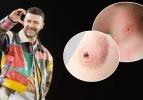 Justin Timberlake gizlediği hastalığını itiraf etti: Lyme hastalığı nedir, neden olur?