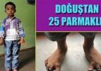 Doğuştan 25 parmaklı &ccedil;ocuk!