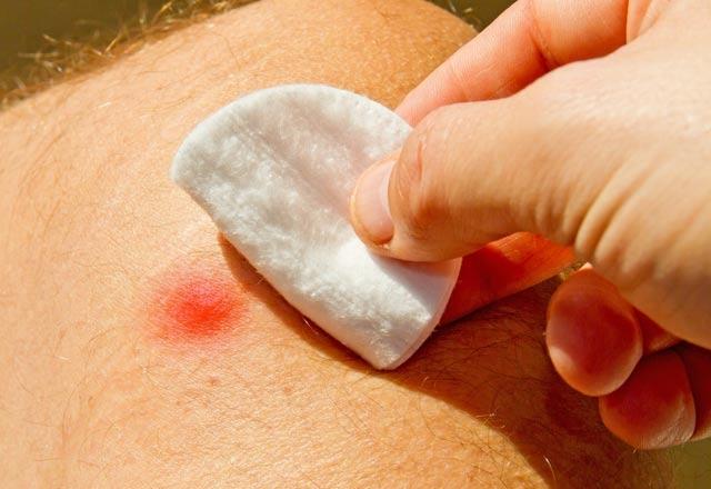 <p><strong>2-</strong> Böcek, sivrisinek ısırması gibi kaşıntılı yaralarınıza tuz ile yapacağınız masaj kaşıntınızı alır. </p>
