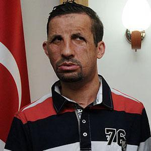 Akdeniz Üniversitesi'nde (AÜ) gerçekleştirilen yüz naklinin ardından 2 ayı aşkın süredir hastanede kalan ve Türkiye'nin ilk yüz nakilli hastası da olan Uğur Acar şimdilerde yeni yüzü ile Akdeniz Üniversitesi'nde iş başı yaptı.