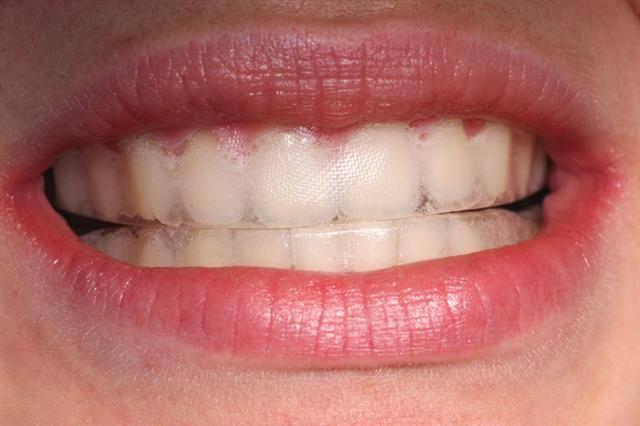 <p><strong>Yanlış uygulamaya klinikte müdahale etme şansı yüksek</strong></p>
<p>Öztürk, klinikte yapılan beyazlatma işlemlerinin hekimin hastanın beklentilerini görerek hareket ve müdahale şansının daha yüksek olduğunu belirtti.</p>